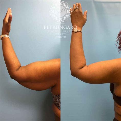 invasive arm fat removal  amparo roberts blog