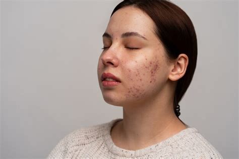 Causes of acne – Drug Information Center