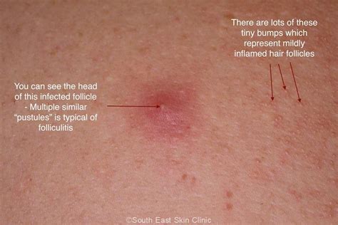 Folliculitis - A term many Australians are familiar with but why?