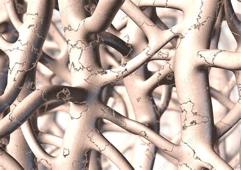 Brittle bone disease - Stock Image - M230/0419 - Science Photo Library