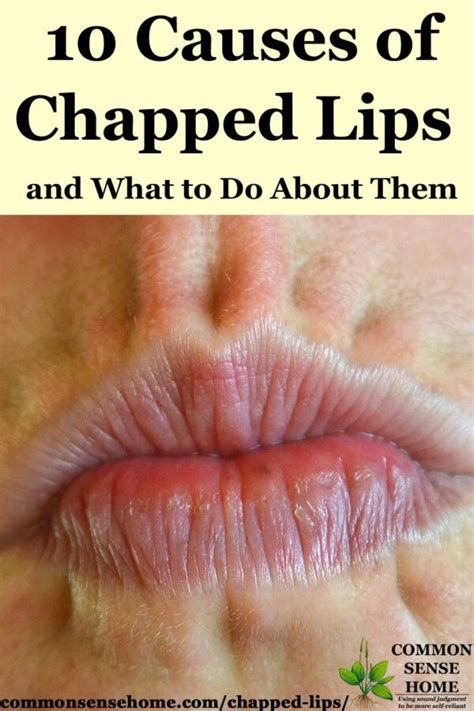 10 Causes of Chapped Lips, Plus How to Get Rid of Chapped Lips