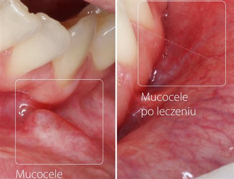 Co to jest, jak wygląda i jak leczyć mucocele? - Dentrum Clinic