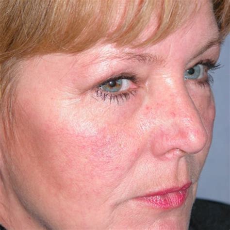 Blepharoplasty - Eyelid Rejuvenation | Plastic Surgeon - Surrey ...