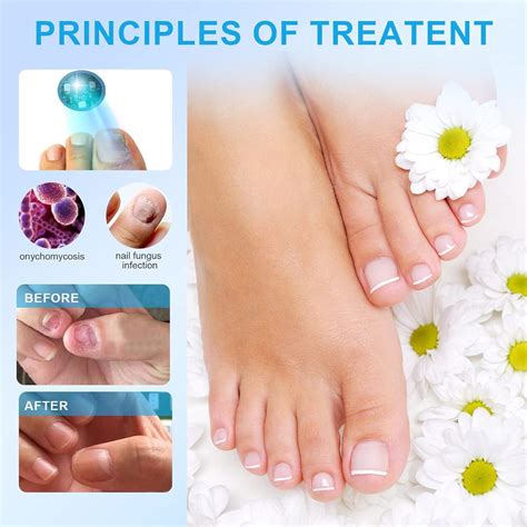 iKeener Nail Fungus Laser Treatment Device - Home Use Pain-Free Fungi