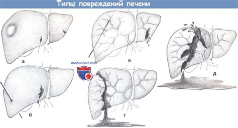 Показания, этапы и техника операции при разрыве печени