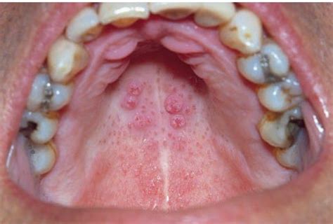 Nicotinic stomatitis - MEDizzy