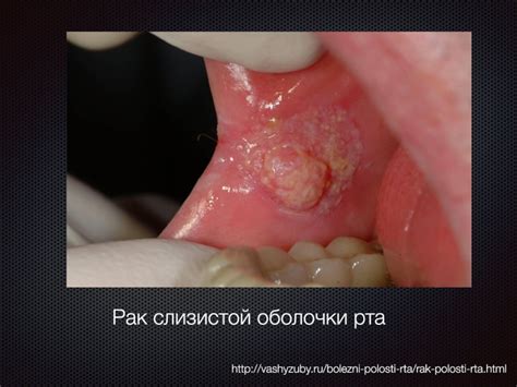 Плоскоклеточный рак
