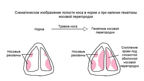 Лечение сломан нос: виды травм, признаки повреждения, диагностика и лечение