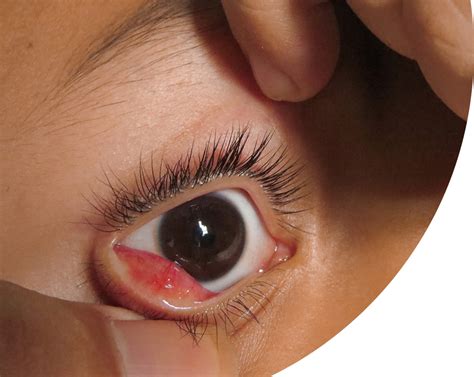 Large popping cysts videos go viral as viewers watch in shock 10