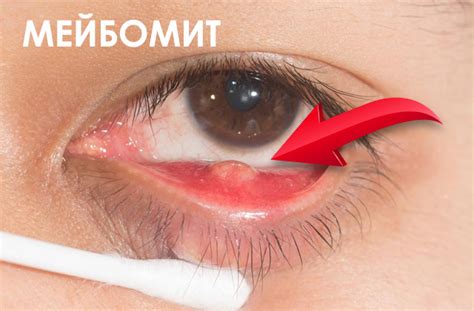 Мейбомит века – причины, симптомы и лечение