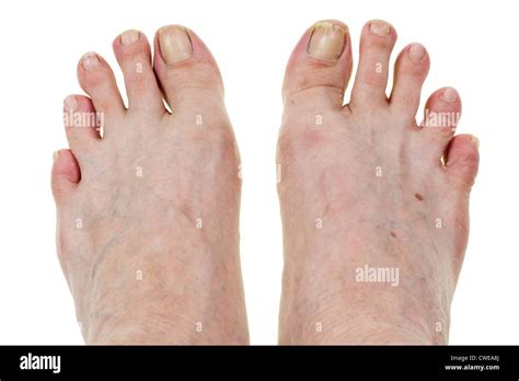 how to fix a crooked toe