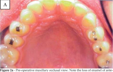 Figure 2 from Aesthetic and functional reestablishment of patient ...