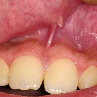 Sewerin's morphological types of maxillary labial frenum. Simple ...