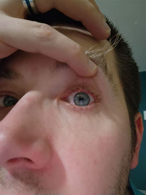 Patients react to finding a lump on the inside of thigh 14