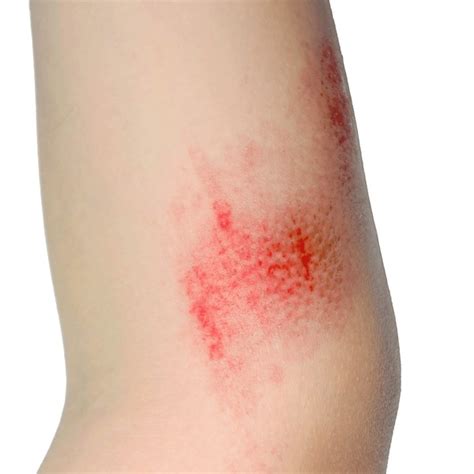 child grazed elbow royalty  images stock  pictures