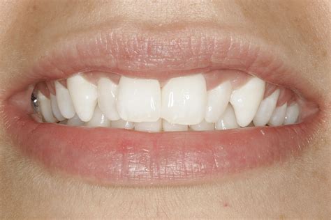 Teeth1 - The Center for Advanced Dentistry's Blog