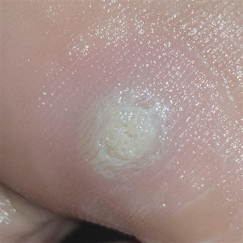 SA + duct tape = plantar wart that looks like a brain : r/Warts