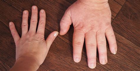 acromegalia    sintomas  tratamentos minha vida