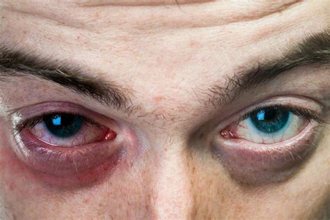 amazing home remedies   rid  black eye