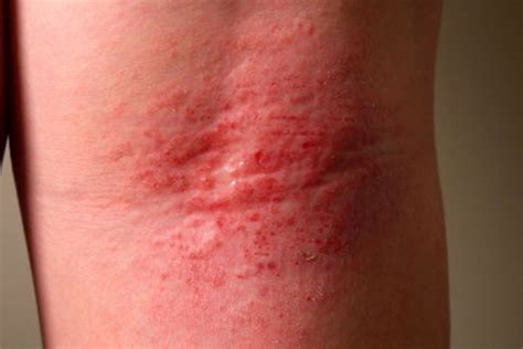Eczema On Arm Crease