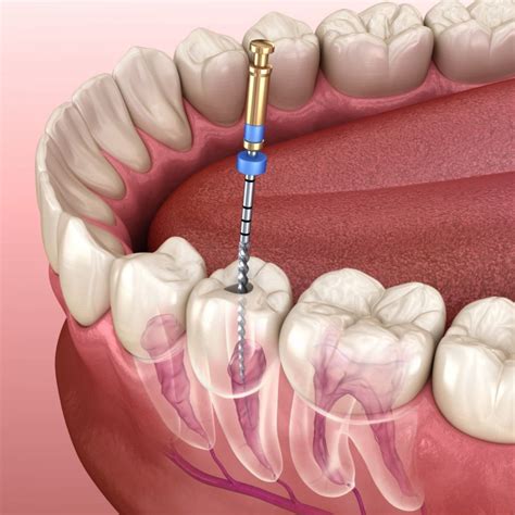 Smile Dent - Kanal Tedavisi (Endodonti)