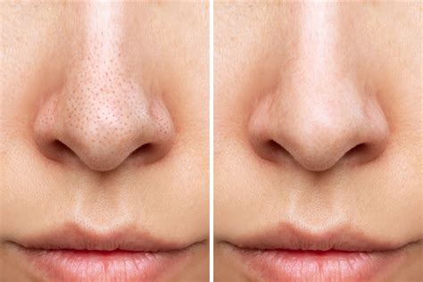 Unbelievable Blackhead Removal 2024: Before And After Photos That Will Shock You! Image 14