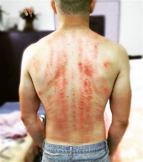 Массаж гуаша спина Массаж Калуга (@massageviktor) в Instagram ...