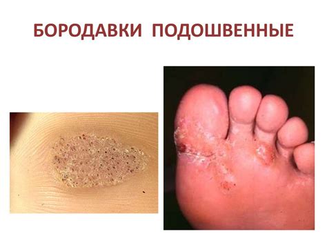 Вирусные заболевания кожи - online presentation