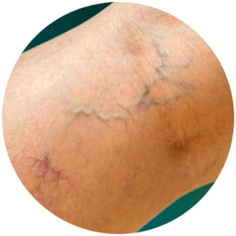 Laser Spider Vein Removal - Total Body Laser - Prince George BC