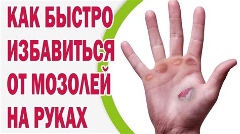 Как избавиться от мозолей на пальцах рук: традиционные методы лечения ...