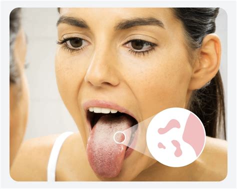 managing oral thrush symptoms  preventative care