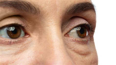 operasi kantung mata klinik utama dr indrajana