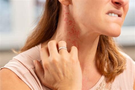hours allergic reaction treatment   rapidcare emergency room