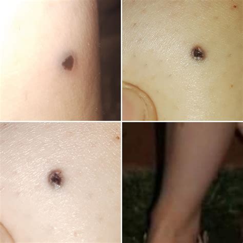 A black spot popped up about a year and a half ago..now its rapidly ...