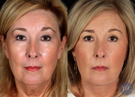 TCA Peels Before & After - Town & Country Plastic Surgeons and Medspa