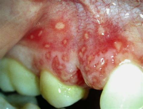 gum ulcer  potential  explained