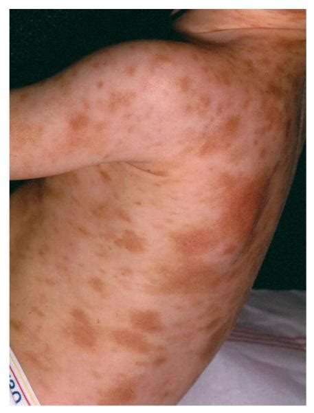 Pediatric mastocytosis: routine anesthetic management for a complex ...
