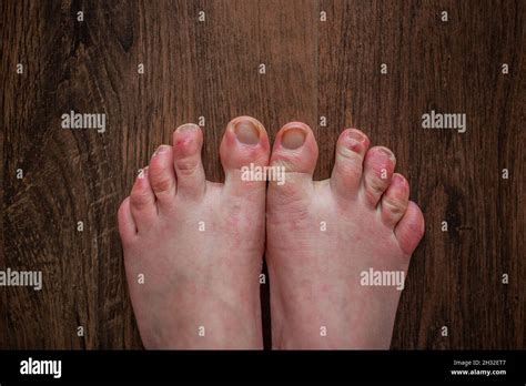 Raynaud's disease feet hi-res stock photography and images - Alamy