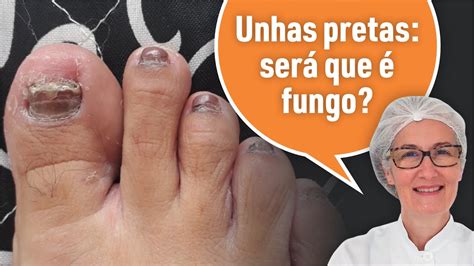 Porque A Unha Do Pé Fica Preta - UNHAS PRETAS: VEJA ESTE CASO - YouTube
