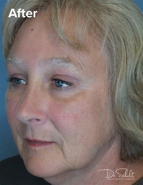 brow lift  dr schalit cosmetic facial specialist