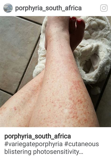 992 best images about PORPHYRIA on Pinterest | Rotterdam, Dna and Gene ...