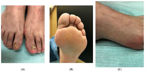 Icd 10 Code For Onychomycosis 4