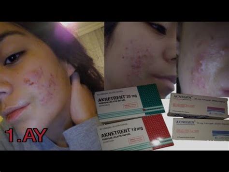 AKNETRENT/ROACCUTANE SİVİLCE TEDAVİ SÜRECİM. (1.Ay) - YouTube