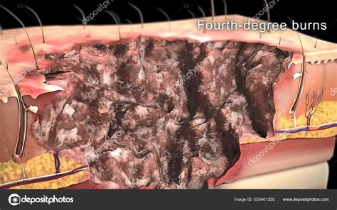First Degree Burn Epidermis Illustration Stock Photo by ©soundpic 553401350