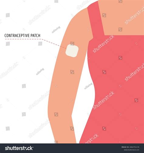 Female Arm Contraception at George Arrellano blog
