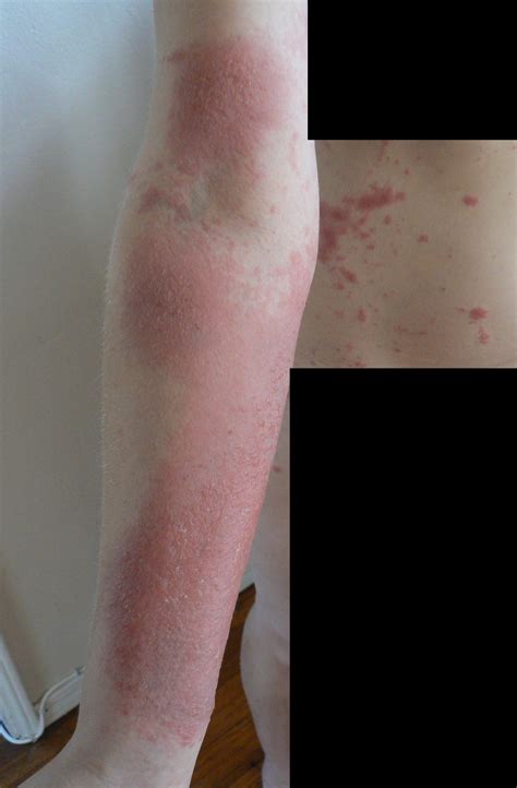 Bad Poison Oak Rash