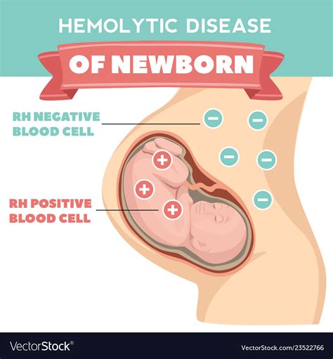 Hemolytic disease newborn infographics detailed Vector Image