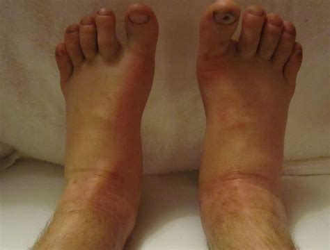 Coronary Heart Disease Warning Signs You Can't Afford To Ignore - Prime