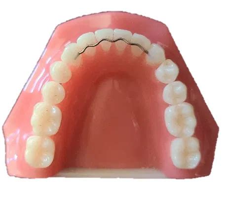 retainers  instructions curtis  kamisugi dds msd aiea