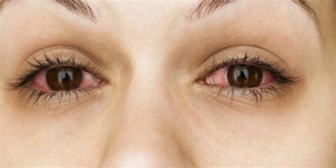 Alergija oka (alergijski konjunktivitis): simptomi, uzroci i lečenje ...